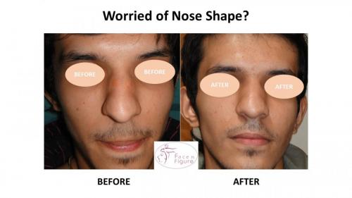 Rhinoplasty- Deviated-Nose -Hump-Surgery-Best-Results-Clinic-Surat-Baroda-Gujarat-Navsari-12