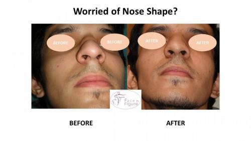 Rhinoplasty- Deviated-Nose -Hump-Surgery-Best-Results-Clinic-Surat-Baroda-Gujarat-Navsari-13