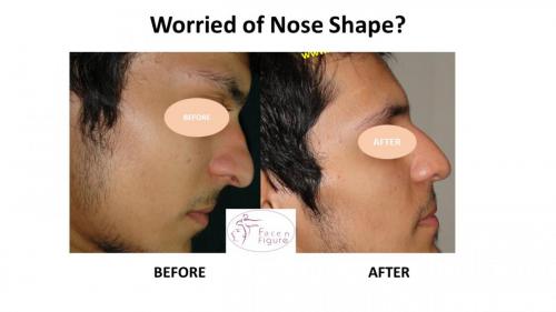 Rhinoplasty- Deviated-Nose -Hump-Surgery-Best-Results-Clinic-Surat-Baroda-Gujarat-Navsari-14