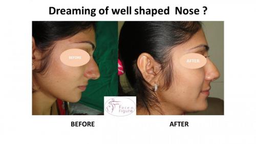 Rhinoplasty- Deviated-Nose -Hump-Surgery-Best-Results-Clinic-Surat-Baroda-Gujarat-Navsari-15