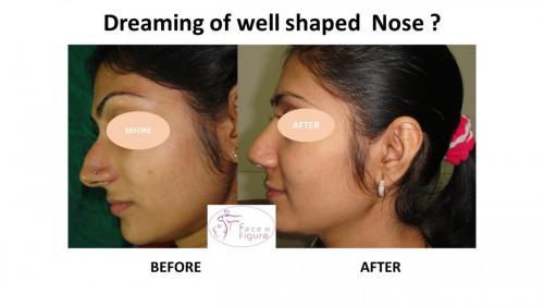 Rhinoplasty- Deviated-Nose -Hump-Surgery-Best-Results-Clinic-Surat-Baroda-Gujarat-Navsari-16