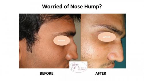 Rhinoplasty- Deviated-Nose -Hump-Surgery-Best-Results-Clinic-Surat-Baroda-Gujarat-Navsari-17