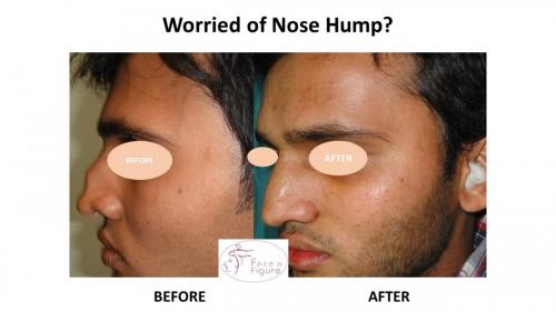 Rhinoplasty- Deviated-Nose -Hump-Surgery-Best-Results-Clinic-Surat-Baroda-Gujarat-Navsari-18