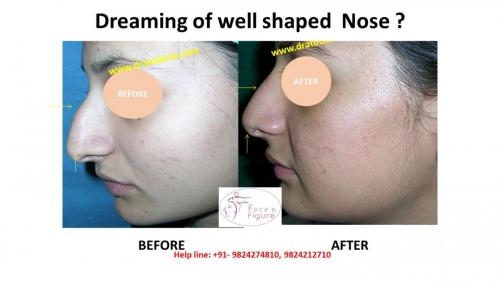 Rhinoplasty- Deviated-Nose -Hump-Surgery-Best-Results-Clinic-Surat-Baroda-Gujarat-Navsari-2