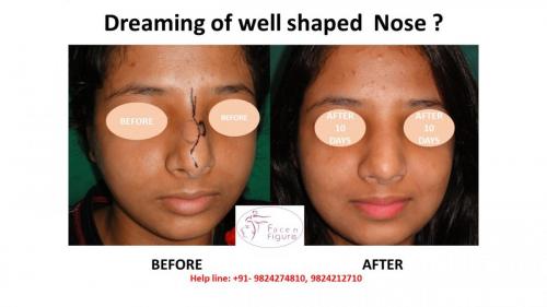 Rhinoplasty- Deviated-Nose -Hump-Surgery-Best-Results-Clinic-Surat-Baroda-Gujarat-Navsari-4