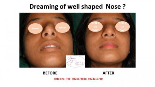 Rhinoplasty- Deviated-Nose -Hump-Surgery-Best-Results-Clinic-Surat-Baroda-Gujarat-Navsari-5