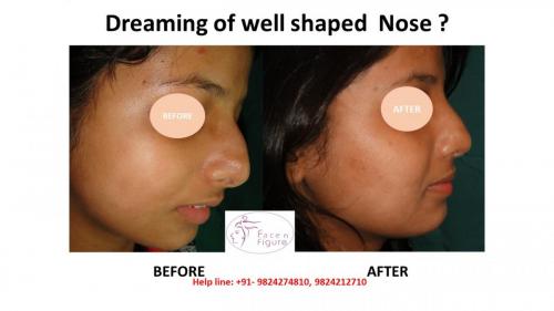 Rhinoplasty- Deviated-Nose -Hump-Surgery-Best-Results-Clinic-Surat-Baroda-Gujarat-Navsari-6