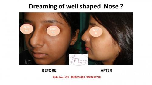 Rhinoplasty- Deviated-Nose -Hump-Surgery-Best-Results-Clinic-Surat-Baroda-Gujarat-Navsari-7