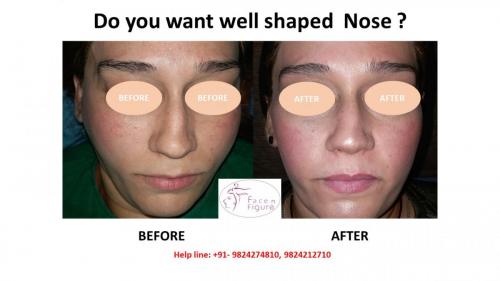 Rhinoplasty- Deviated-Nose -Hump-Surgery-Best-Results-Clinic-Surat-Baroda-Gujarat-Navsari-8