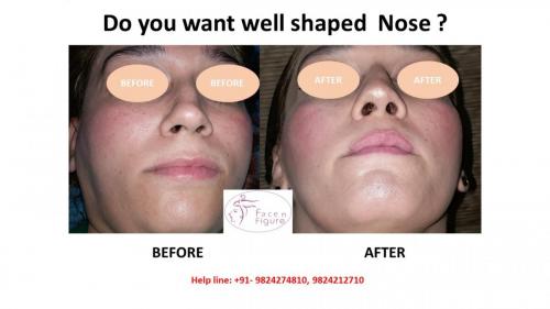 Rhinoplasty- Deviated-Nose -Hump-Surgery-Best-Results-Clinic-Surat-Baroda-Gujarat-Navsari-9