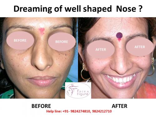 Rhinoplasty- Deviated-Nose -Surgery-Best-Results-Clinic-Surat-Baroda-Gujarat-Navsari-1