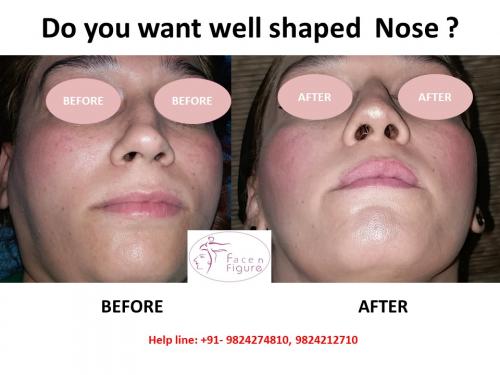 Rhinoplasty- Deviated-Nose -Surgery-Best-Results-Clinic-Surat-Baroda-Gujarat-Navsari-15