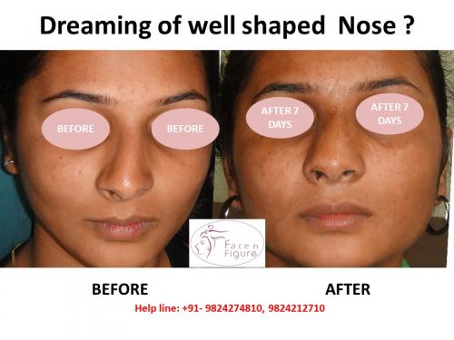 Rhinoplasty- Deviated-Nose -Surgery-Best-Results-Clinic-Surat-Baroda-Gujarat-Navsari-21