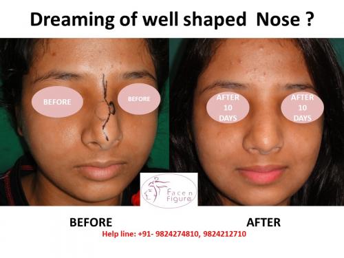 Rhinoplasty- Deviated-Nose -Surgery-Best-Results-Clinic-Surat-Baroda-Gujarat-Navsari-23