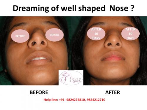 Rhinoplasty- Deviated-Nose -Surgery-Best-Results-Clinic-Surat-Baroda-Gujarat-Navsari-24