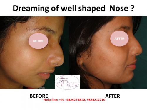Rhinoplasty- Deviated-Nose -Surgery-Best-Results-Clinic-Surat-Baroda-Gujarat-Navsari-25