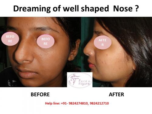 Rhinoplasty- Deviated-Nose -Surgery-Best-Results-Clinic-Surat-Baroda-Gujarat-Navsari-26