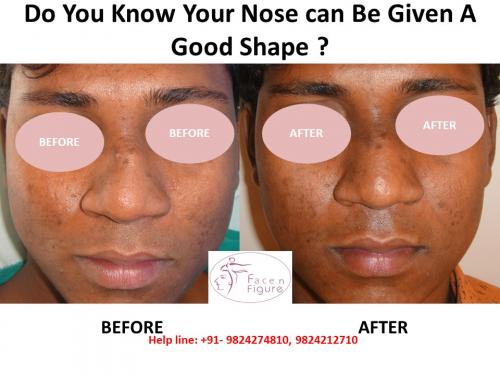 Rhinoplasty- Deviated-Nose -Surgery-Best-Results-Clinic-Surat-Baroda-Gujarat-Navsari-3