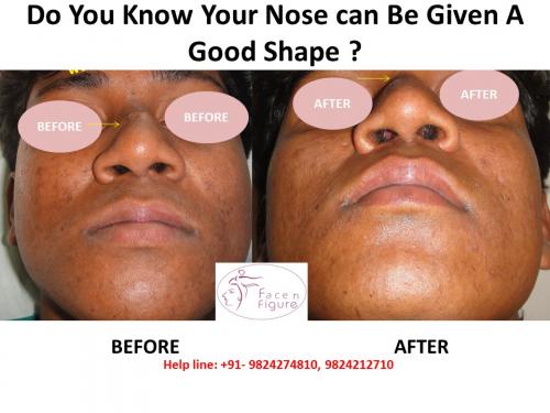 Rhinoplasty- Deviated-Nose -Surgery-Best-Results-Clinic-Surat-Baroda-Gujarat-Navsari-4