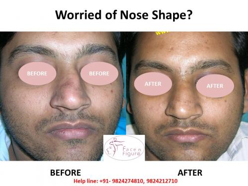 Rhinoplasty- Deviated-Nose -Surgery-Best-Results-Clinic-Surat-Baroda-Gujarat-Navsari-5