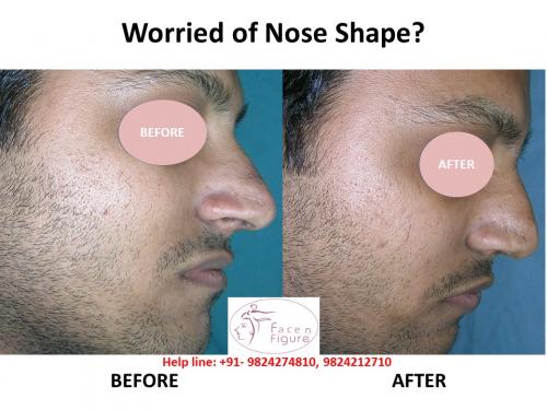 Rhinoplasty- Deviated-Nose -Surgery-Best-Results-Clinic-Surat-Baroda-Gujarat-Navsari-6