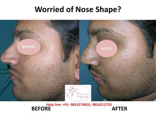 Rhinoplasty- Deviated-Nose -Surgery-Best-Results-Clinic-Surat-Baroda-Gujarat-Navsari-7