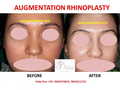 Rhinoplasty-Nose -Surgery-Best-Results-Clinic-Surat-Baroda-Gujarat-Navsari-