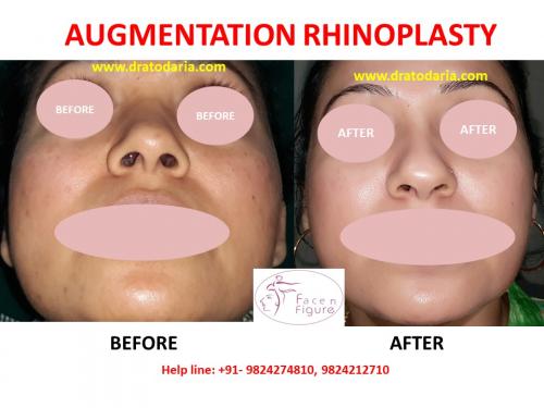 Rhinoplasty-Nose -Surgery-Best-Results-Clinic-Surat-Baroda-Gujarat-Navsari--1