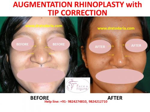 Rhinoplasty- Nose -Surgery-Best-Results-Clinic-Surat-Baroda-Gujarat-Navsari-1