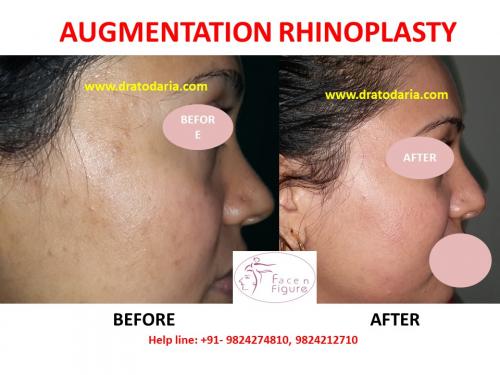 Rhinoplasty-Nose -Surgery-Best-Results-Clinic-Surat-Baroda-Gujarat-Navsari--2