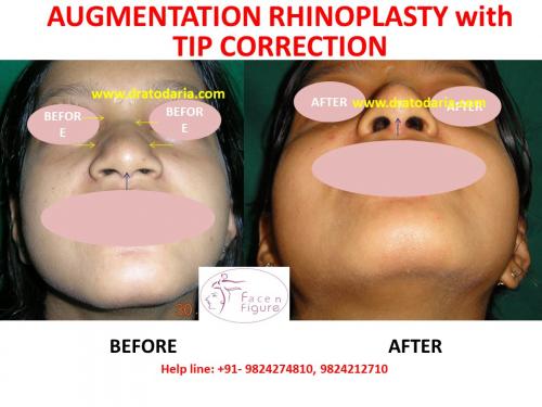 Rhinoplasty- Nose -Surgery-Best-Results-Clinic-Surat-Baroda-Gujarat-Navsari-2