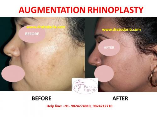 Rhinoplasty-Nose -Surgery-Best-Results-Clinic-Surat-Baroda-Gujarat-Navsari--3