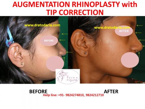 Rhinoplasty- Nose -Surgery-Best-Results-Clinic-Surat-Baroda-Gujarat-Navsari-3