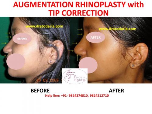 Rhinoplasty- Nose -Surgery-Best-Results-Clinic-Surat-Baroda-Gujarat-Navsari-4