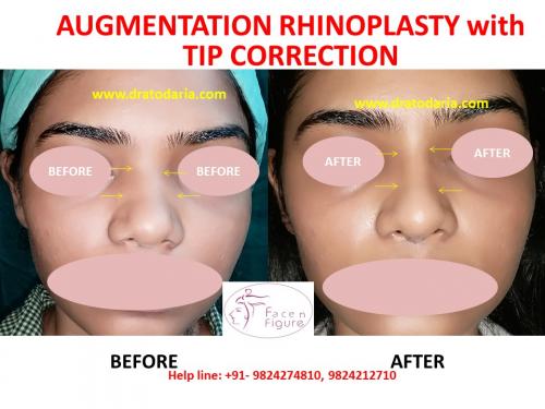 Rhinoplasty- Nose -Surgery-Best-Results-Clinic-Surat-Baroda-Gujarat-Navsari-Bharuch-1