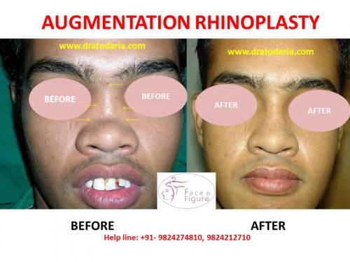 Rhinoplasty- Nose -Surgery-Best-Results-Clinic-Surat-Baroda-Gujarat-Navsari-Bharuch-10