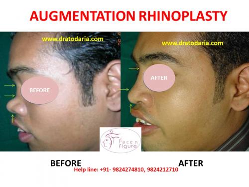 Rhinoplasty- Nose -Surgery-Best-Results-Clinic-Surat-Baroda-Gujarat-Navsari-Bharuch-11