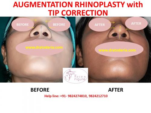 Rhinoplasty- Nose -Surgery-Best-Results-Clinic-Surat-Baroda-Gujarat-Navsari-Bharuch-2