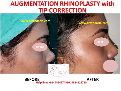 Rhinoplasty- Nose -Surgery-Best-Results-Clinic-Surat-Baroda-Gujarat-Navsari-Bharuch-3