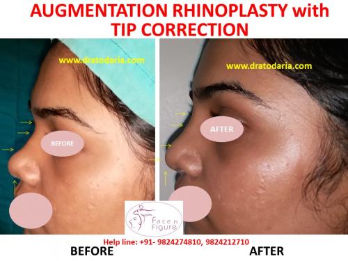 Rhinoplasty- Nose -Surgery-Best-Results-Clinic-Surat-Baroda-Gujarat-Navsari-Bharuch-4