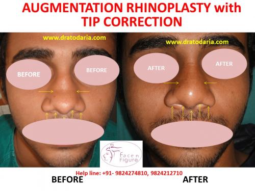 Rhinoplasty- Nose -Surgery-Best-Results-Clinic-Surat-Baroda-Gujarat-Navsari-Bharuch-5