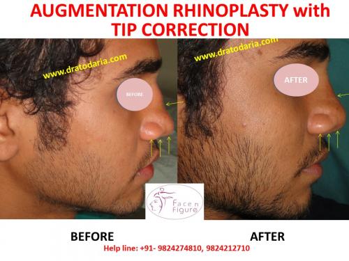 Rhinoplasty- Nose -Surgery-Best-Results-Clinic-Surat-Baroda-Gujarat-Navsari-Bharuch-6