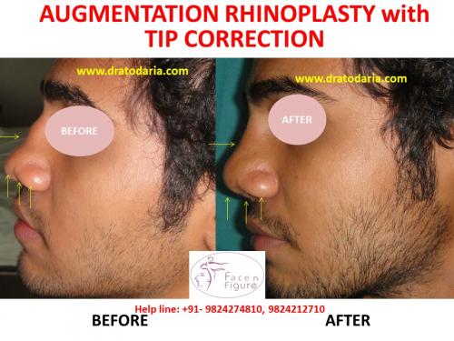 Rhinoplasty- Nose -Surgery-Best-Results-Clinic-Surat-Baroda-Gujarat-Navsari-Bharuch-7