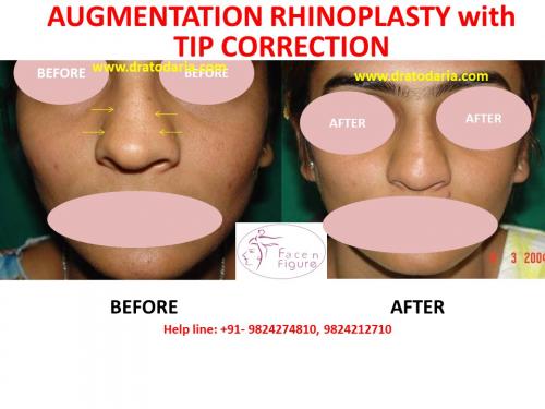 Rhinoplasty- Nose -Surgery-Best-Results-Clinic-Surat-Baroda-Gujarat-Navsari-Bharuch-8