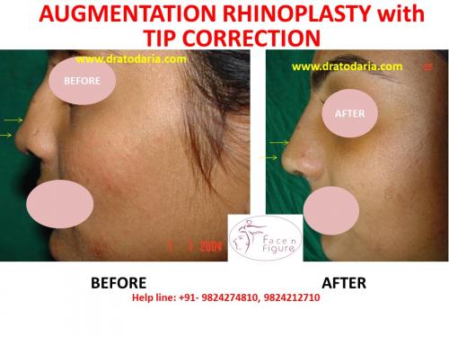 Rhinoplasty- Nose -Surgery-Best-Results-Clinic-Surat-Baroda-Gujarat-Navsari-Bharuch-9