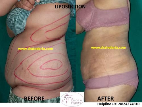 Liposuction-women-love handles-tummy-surat-best-results-clinic-usa-uk