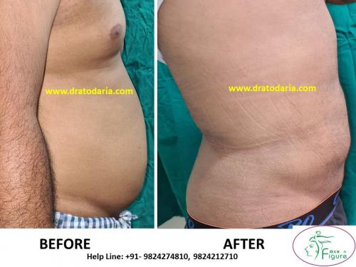 Liposuction-women-love handles-tummy-surat-best-results-clinic-usa-uk