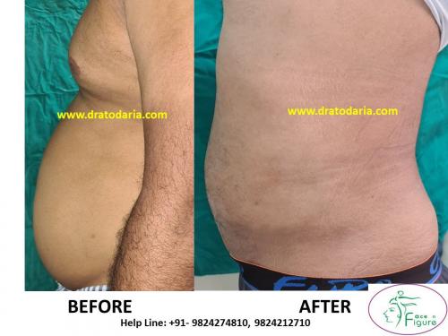 Liposuction-women-love handles-tummy-surat-best-results-clinic-usa-uk