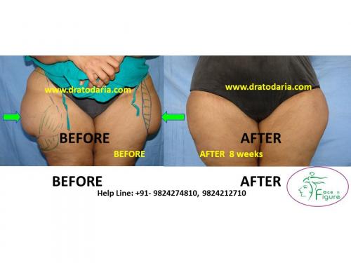 Liposuction-thigh-saddle bags-surat-bharuc-navsari-valsad-usa-uk-best-clinic-results-India-4