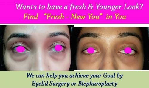 blepharoplasty-eyelid-nose-surgery-surat-valsad-navsari-bharuch-vapi-uk-2